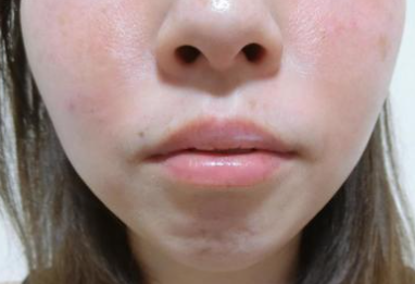 赤ら顔（酒さ）